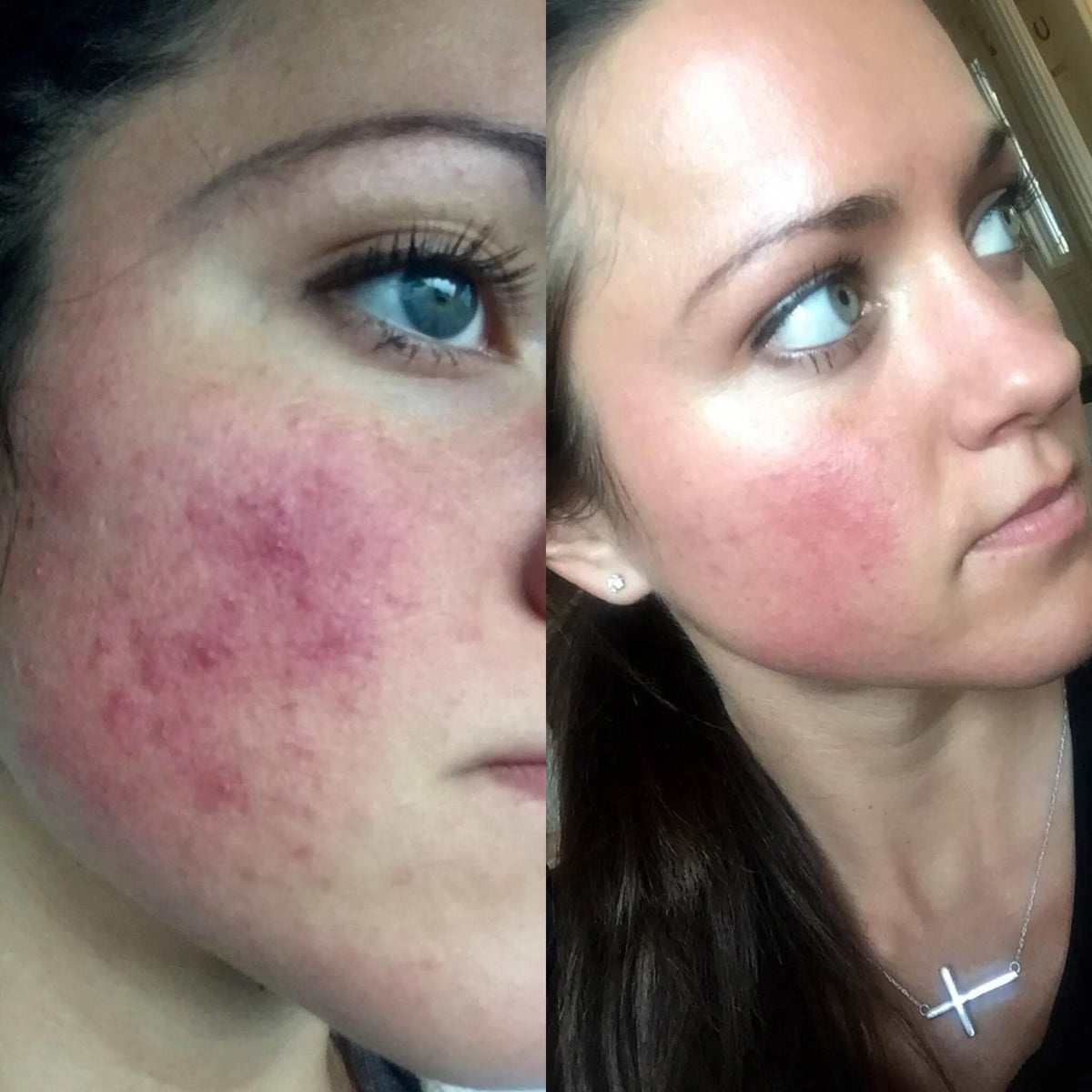 Customer before and after photo showing skin improvement