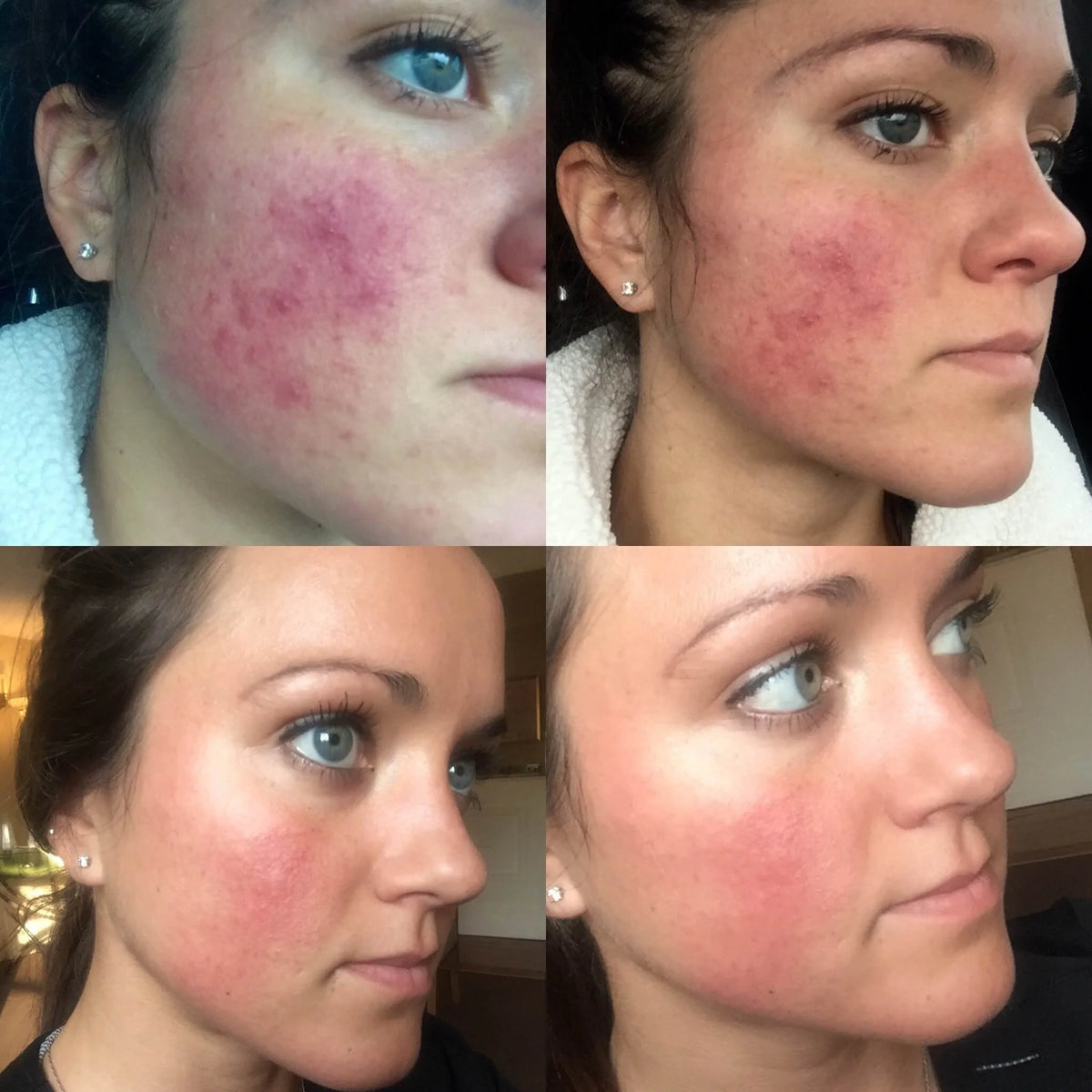 Customer before and after photo showing skin improvement