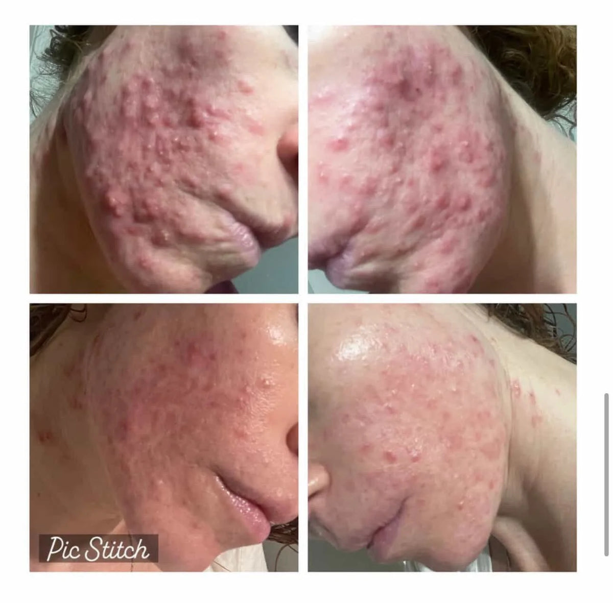 A collage of four close-up images showing before and after results of a skincare treatment