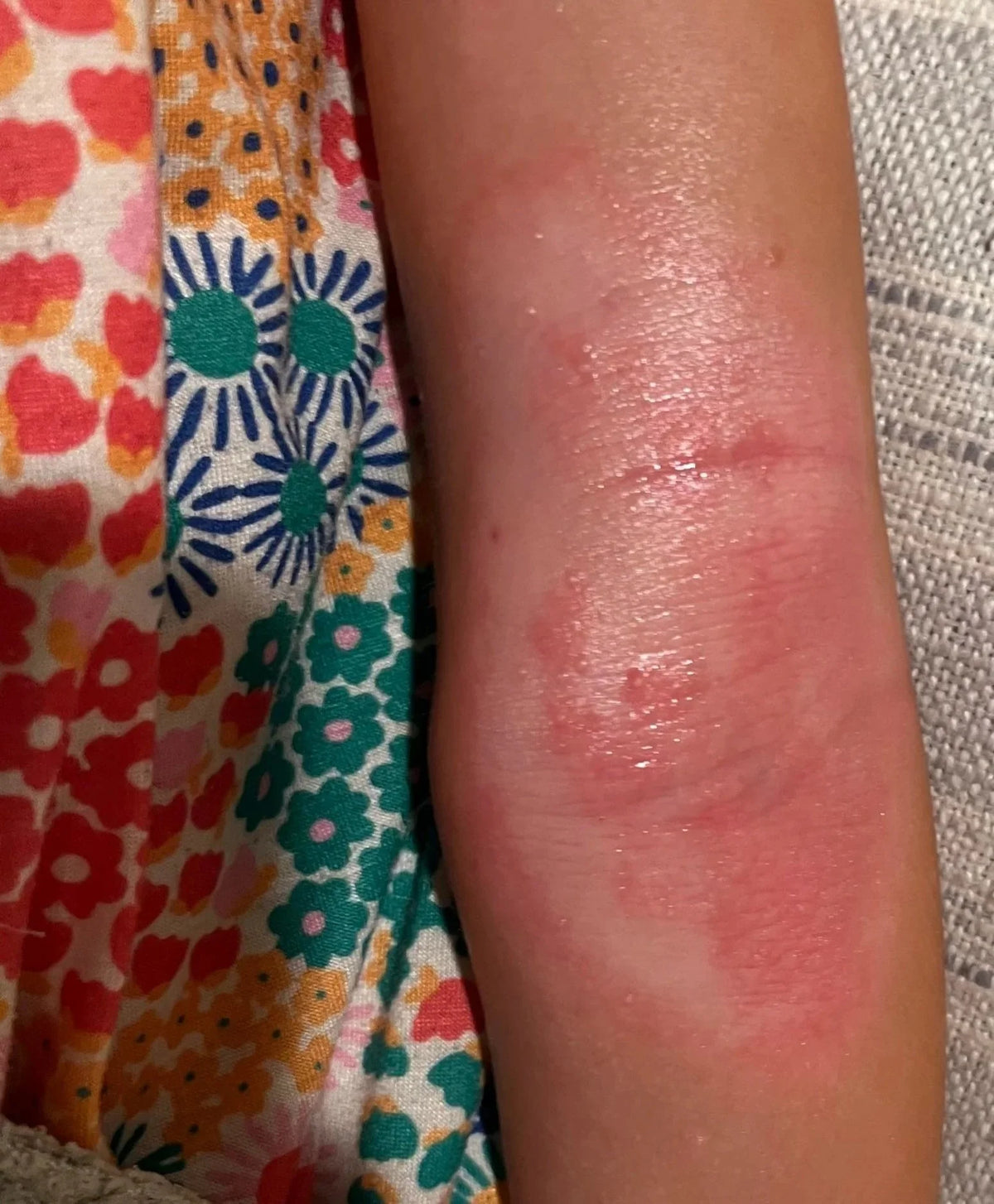 A person's arm with visible redness and irritation