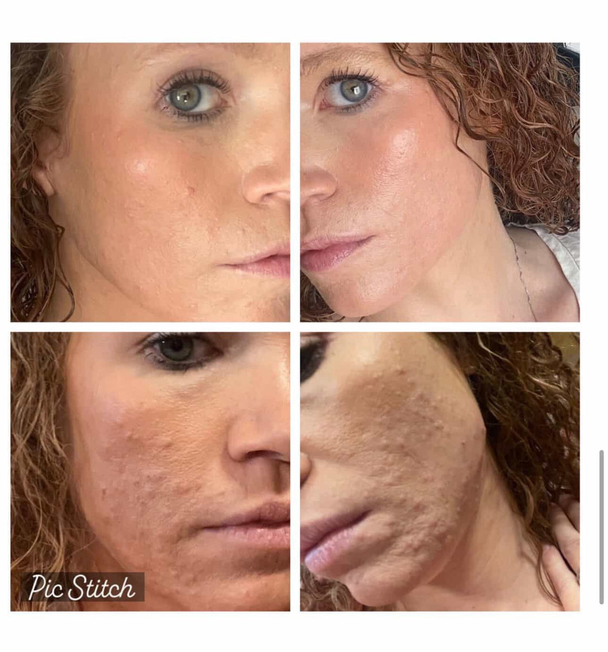 Comparison of a woman's facial skin before and after skincare treatment, showing improvements in skin texture