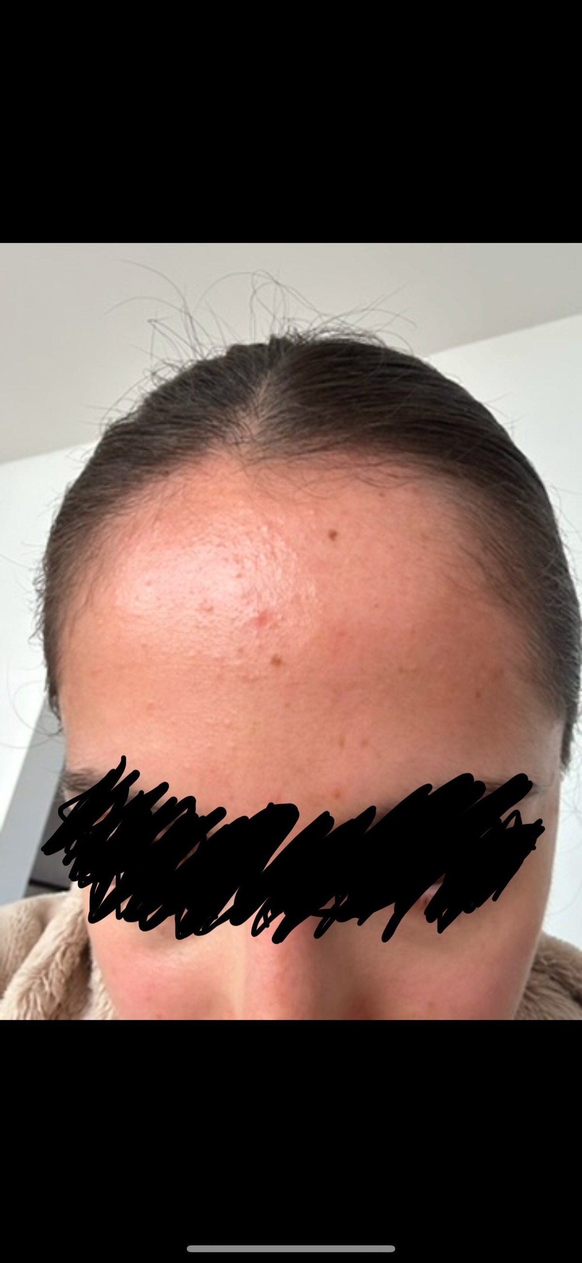 Close-up of a person's forehead and hairline