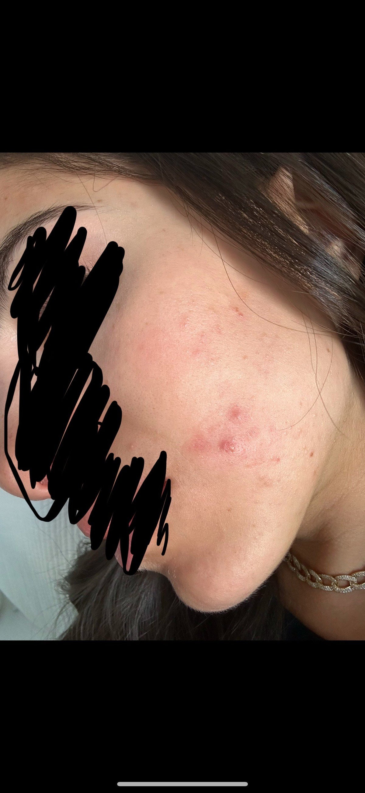 Close-up of a person's face with acne and redness on the cheek