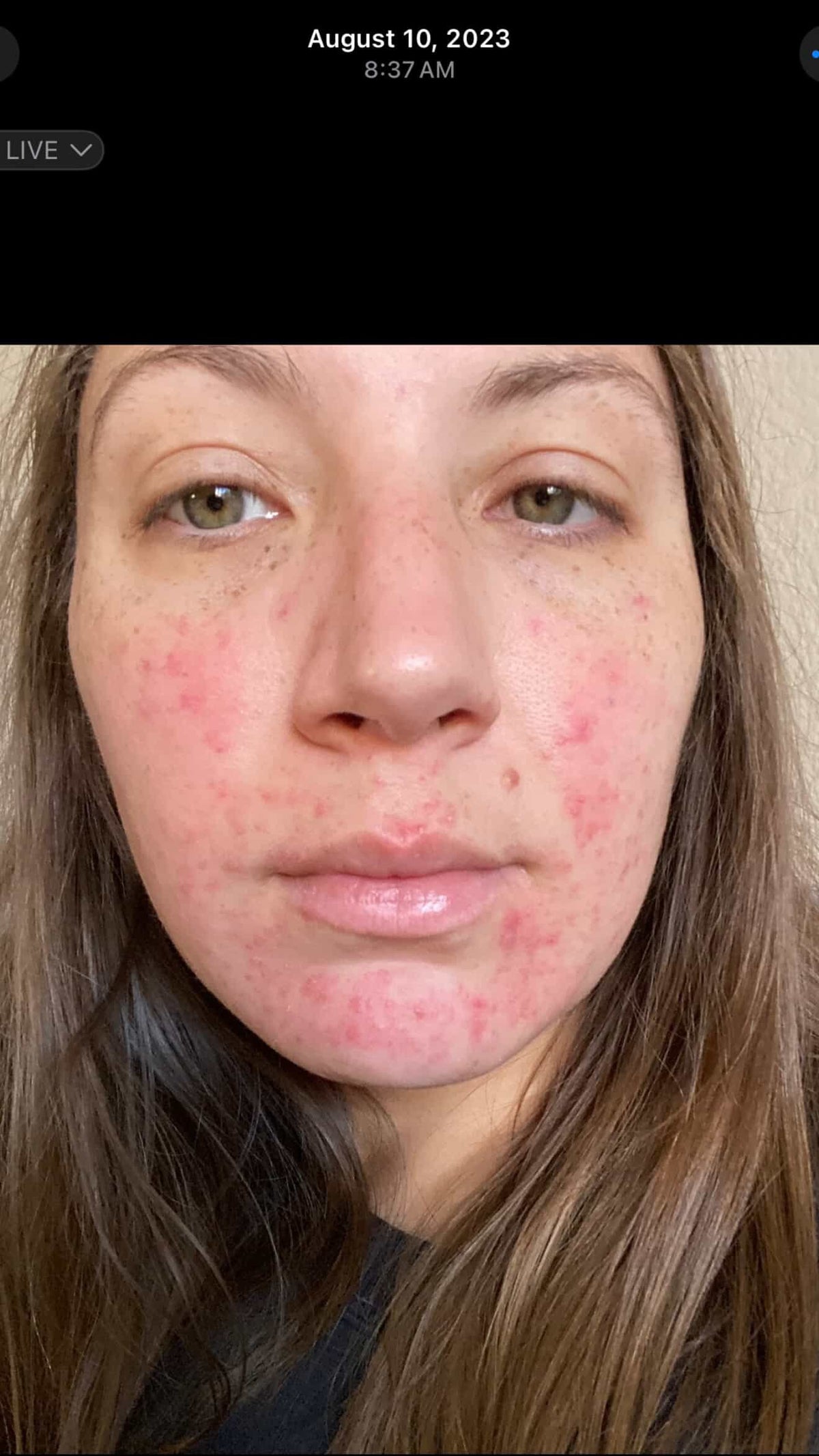 Close-up of a woman with acne and redness on her face