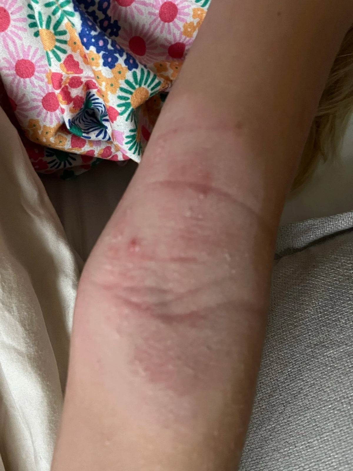 Close-up of a person's arm with multiple scratch marks and redness